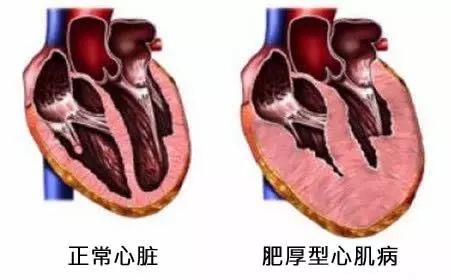 肥厚型心肌病与公务员考试的关联探讨，可行性分析视角