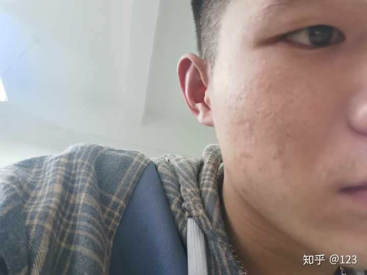 脸上痘坑对警察面试的影响，探讨与解析