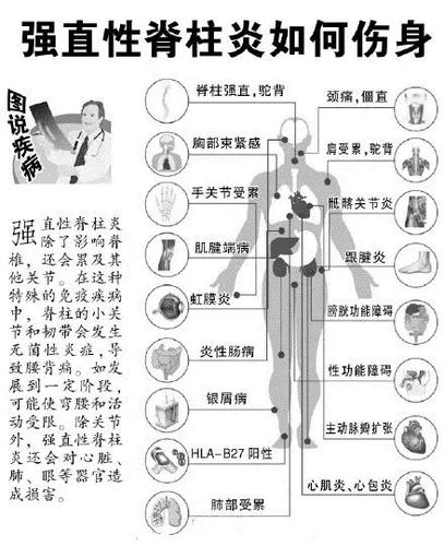 部队新规下强直性脊柱炎的管理与治疗方法探讨