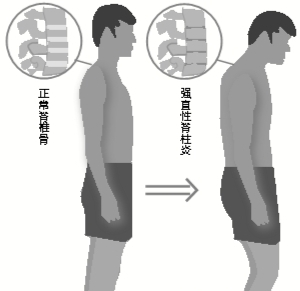 强直患者参与公务员考试的前景探讨与解析